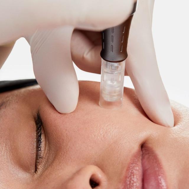 O₃ Microneedling